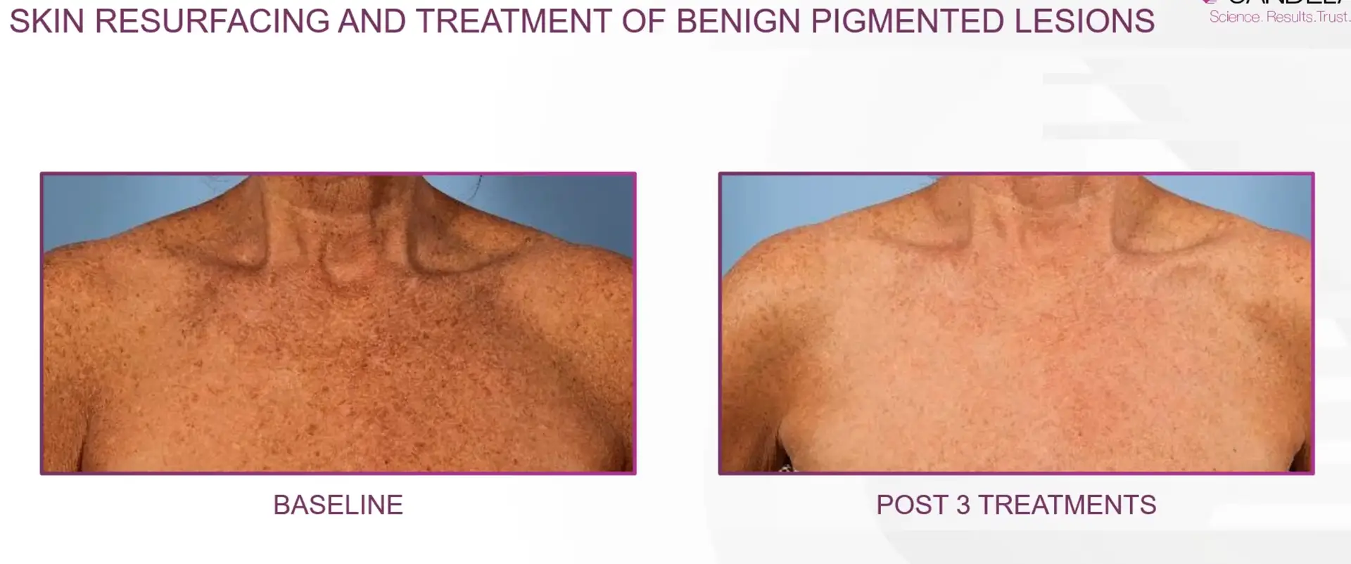 Skin resurfacing | before and after | Advanced Care & Medspa | Lisle, IL